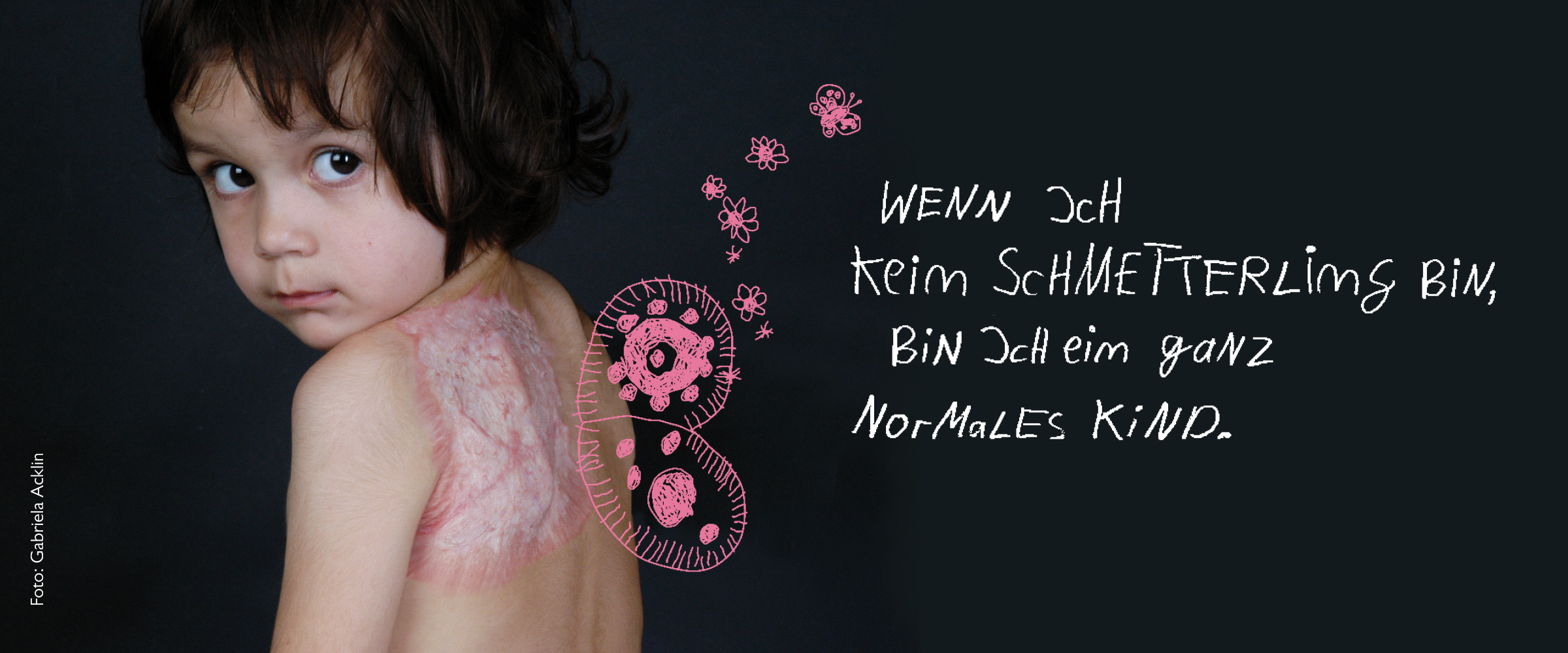 "Wenn ich kein Schmetterling bin, bin ich ein ganz normales Kind." Kleines Mädchen mit Brandnarben.